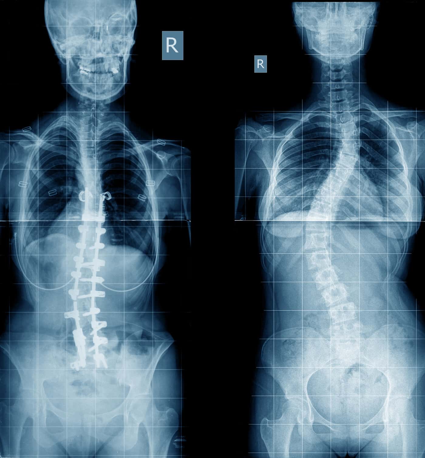 penyakit skoliosis adalah kelaianan tulang belakang yang melengkung ke samping
