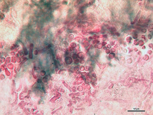 infeksi jamur penyebab penyakit kulit